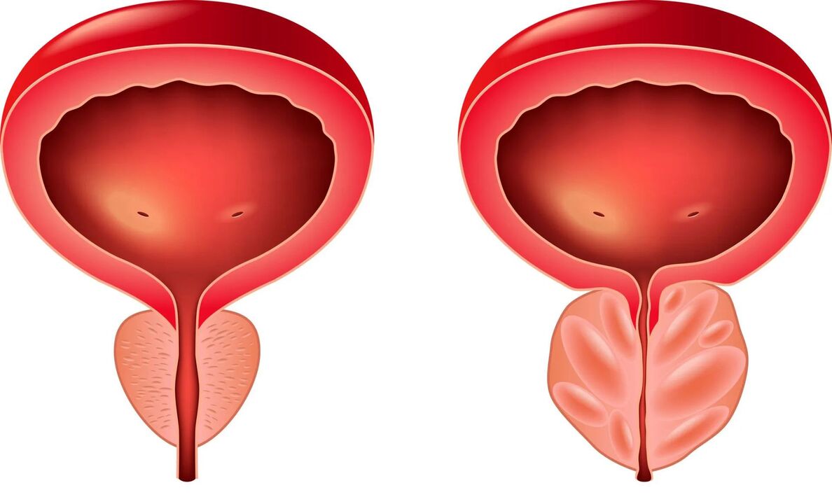 prostata normale e malata