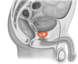 Vospalenie della prostata