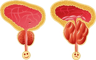 La prostata normale e infiammato